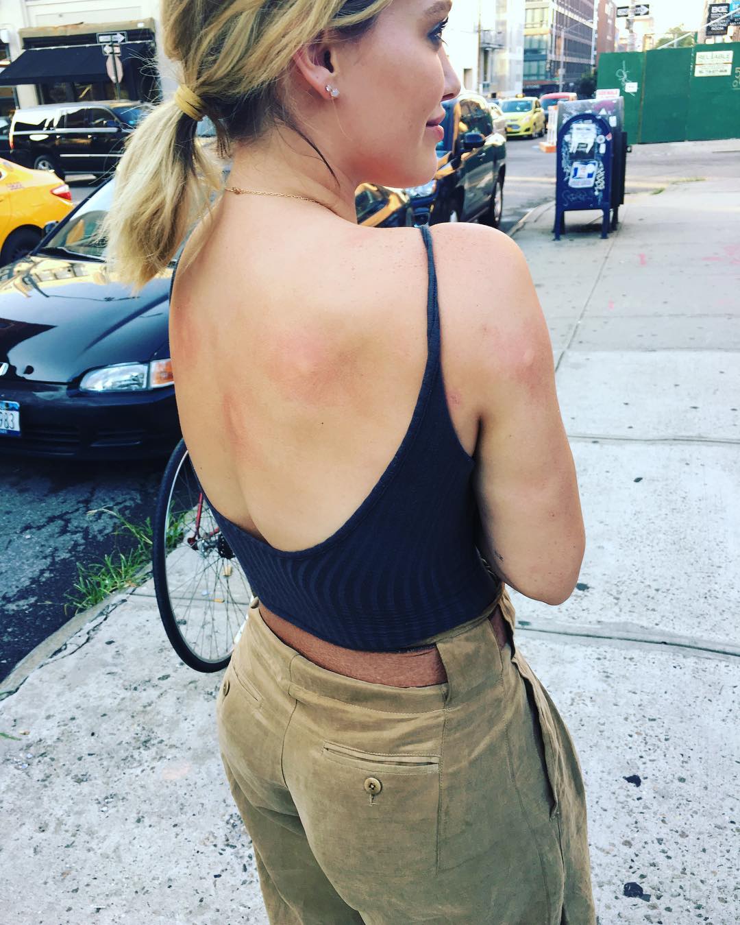 15 juli: Mosquitos had a feast 😩
